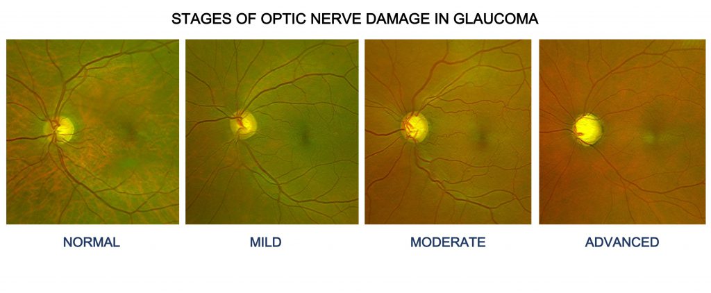 PATIENT CONSULTATION FLOW – GLAUCOMA CLINIC AT AEH
